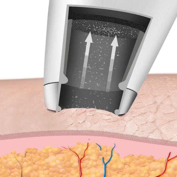 Microdermoabrasão Peeling
