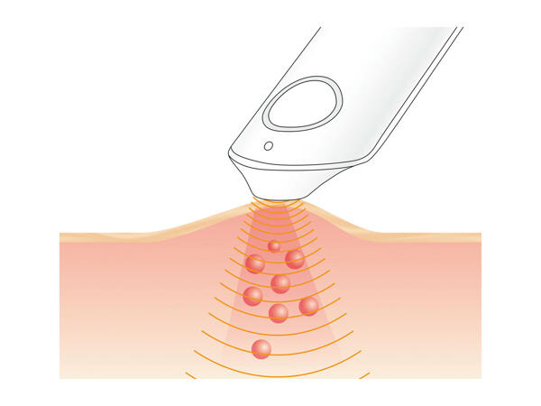 Sanitas Insect Bite Relief Tool